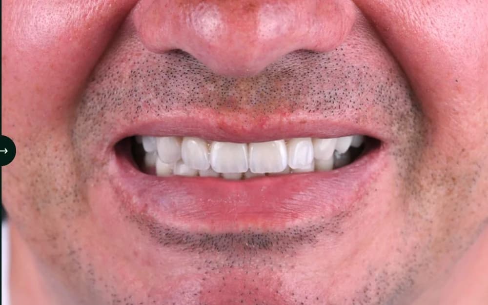 A Batteesee patient's finished result