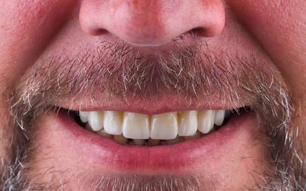 A Batteesee patient's finished result