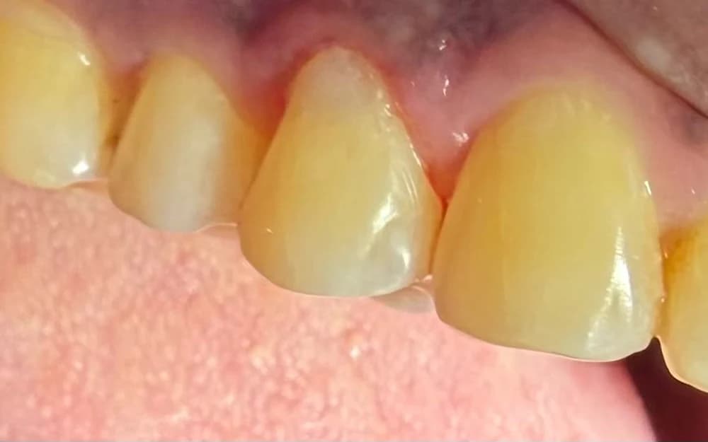 A Batteesee patient's finished result