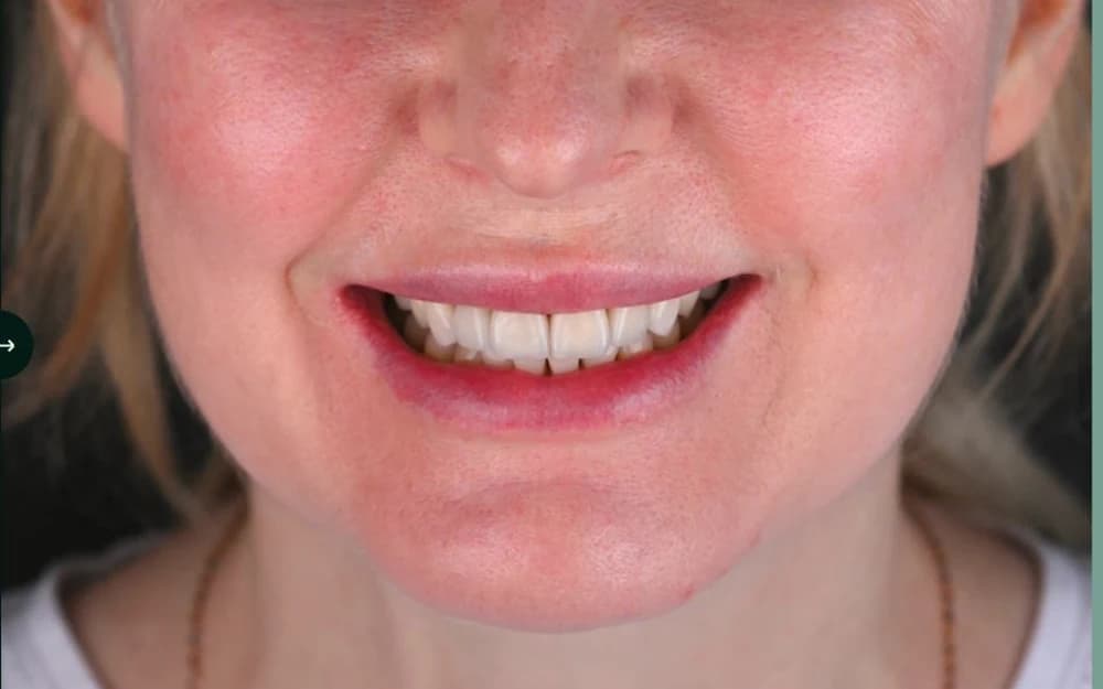 A Batteesee patient's finished result