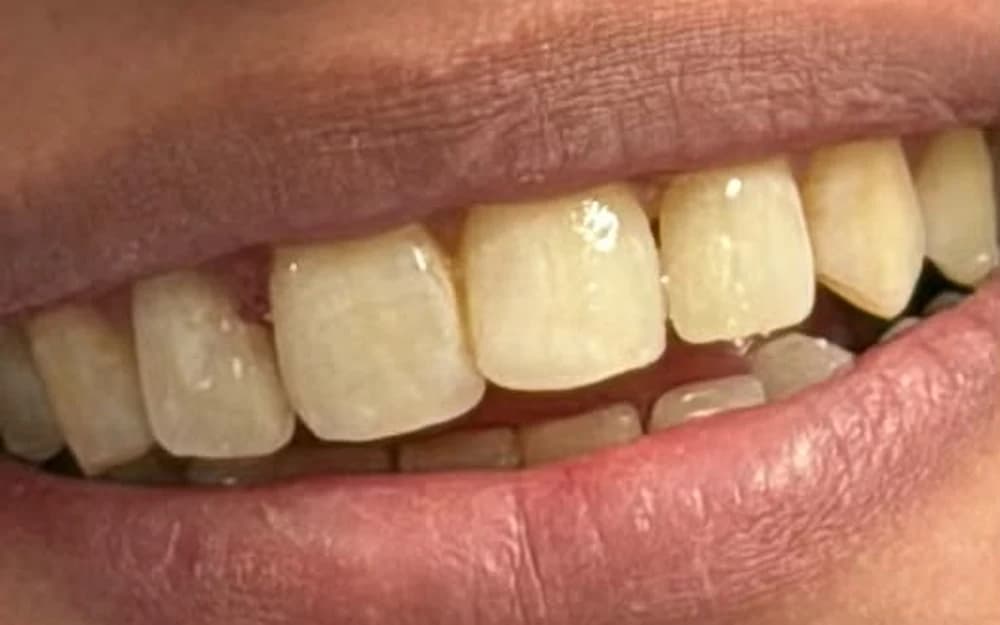A Batteesee patient's finished result